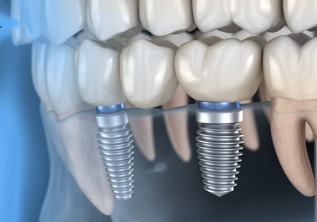 Clínica Para Implantes Dentários em Juiz de Fora