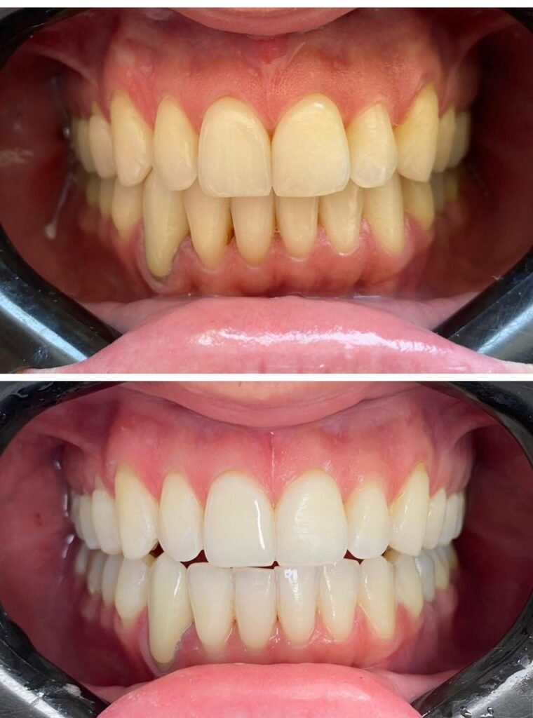 Clareamento Dental Santana