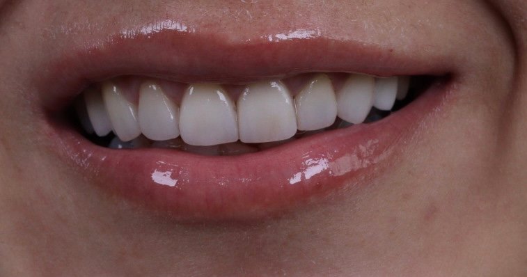 Lentes de Contato Dental