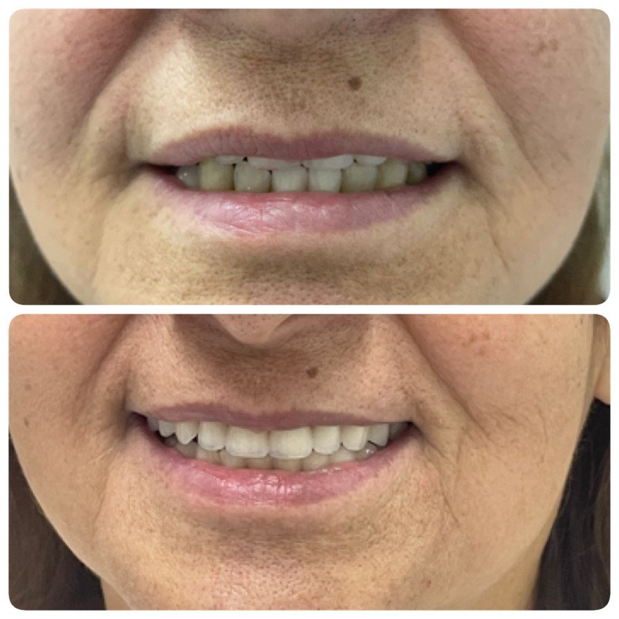 Prótese Dentária Santana Antes e Depois